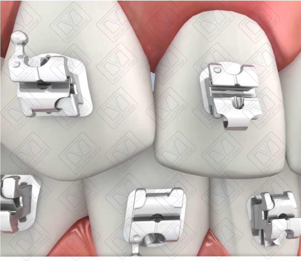 Brackets 3M KIT VICTORY Autoligado Depósito Dental VQ
